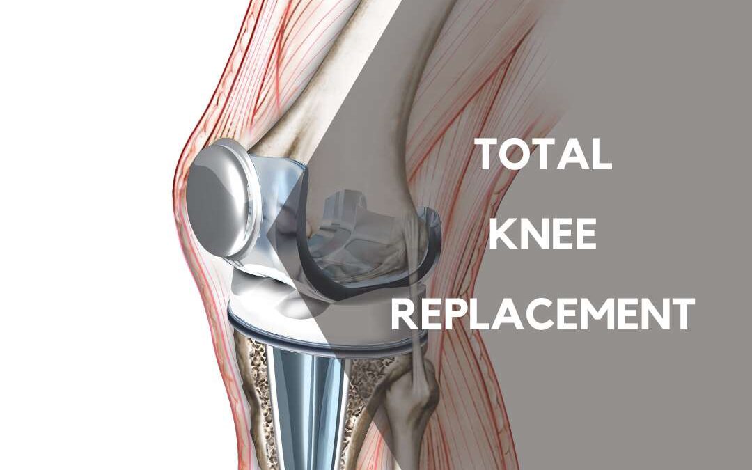 Understanding Total Knee Replacement: Making an Informed Decision